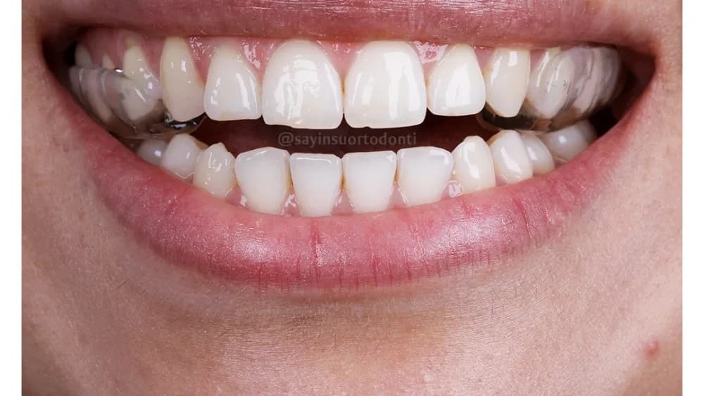 Splint yazısının kapak görseli
