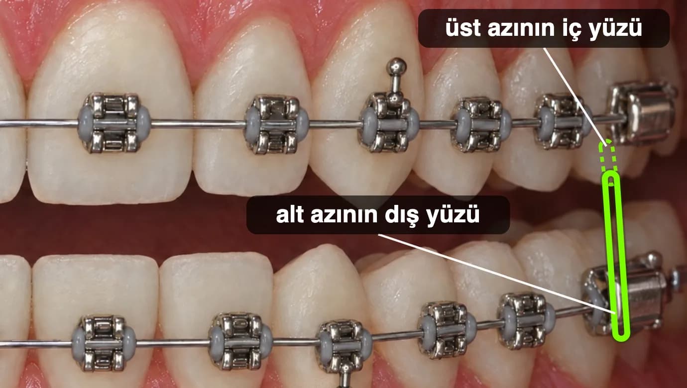 Yakın görünüm: üst azı dişinin iç yüzünden alt azı dişinin dış yüzüne takılmış çapraz lastik.