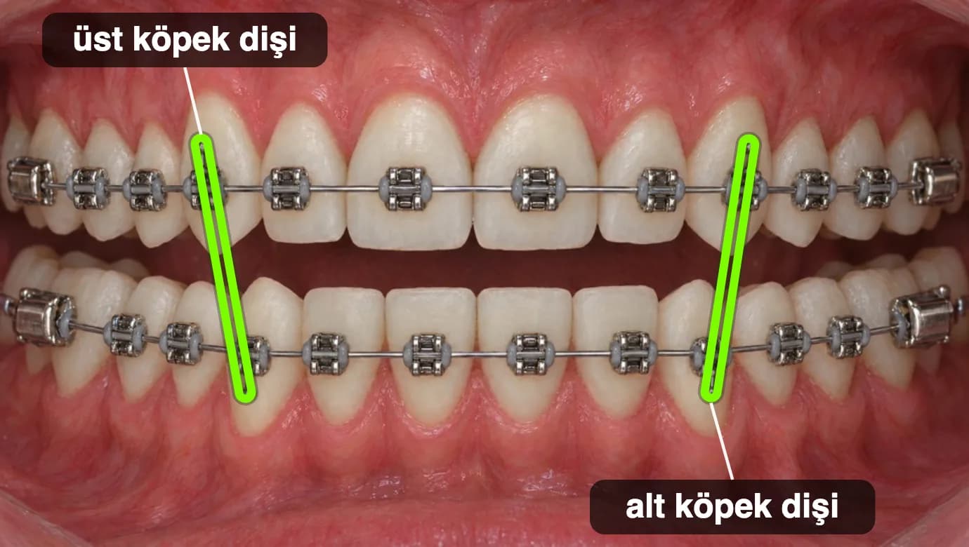 Önden görünüm: üst ve alt köpek dişleri arasına iki yanda dikey takılmış lastikler.