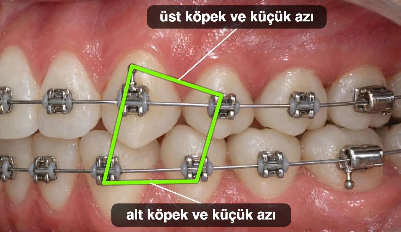 Üst ve alt köpek ve küçük azı dişleri arasında kutu şeklinde takılmış lastik.