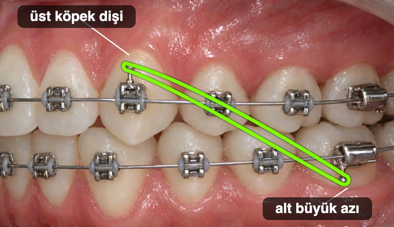 Braketli dişlerde üst köpek dişinin kancasından alt büyük azı dişine takılmış Sınıf II lastik.