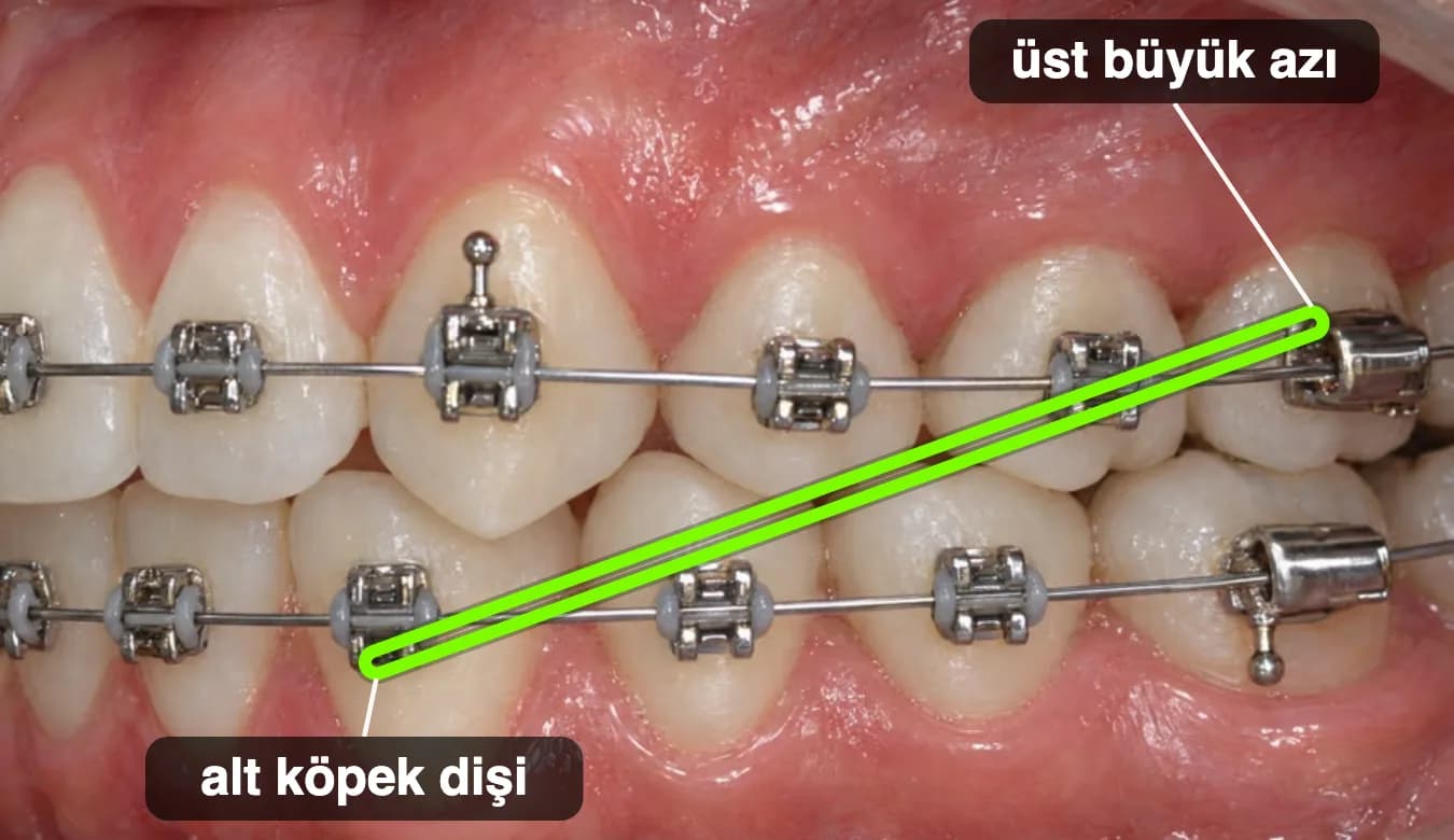Braketli dişlerde alt köpek dişinden üst büyük azı dişine takılmış Sınıf III lastik.