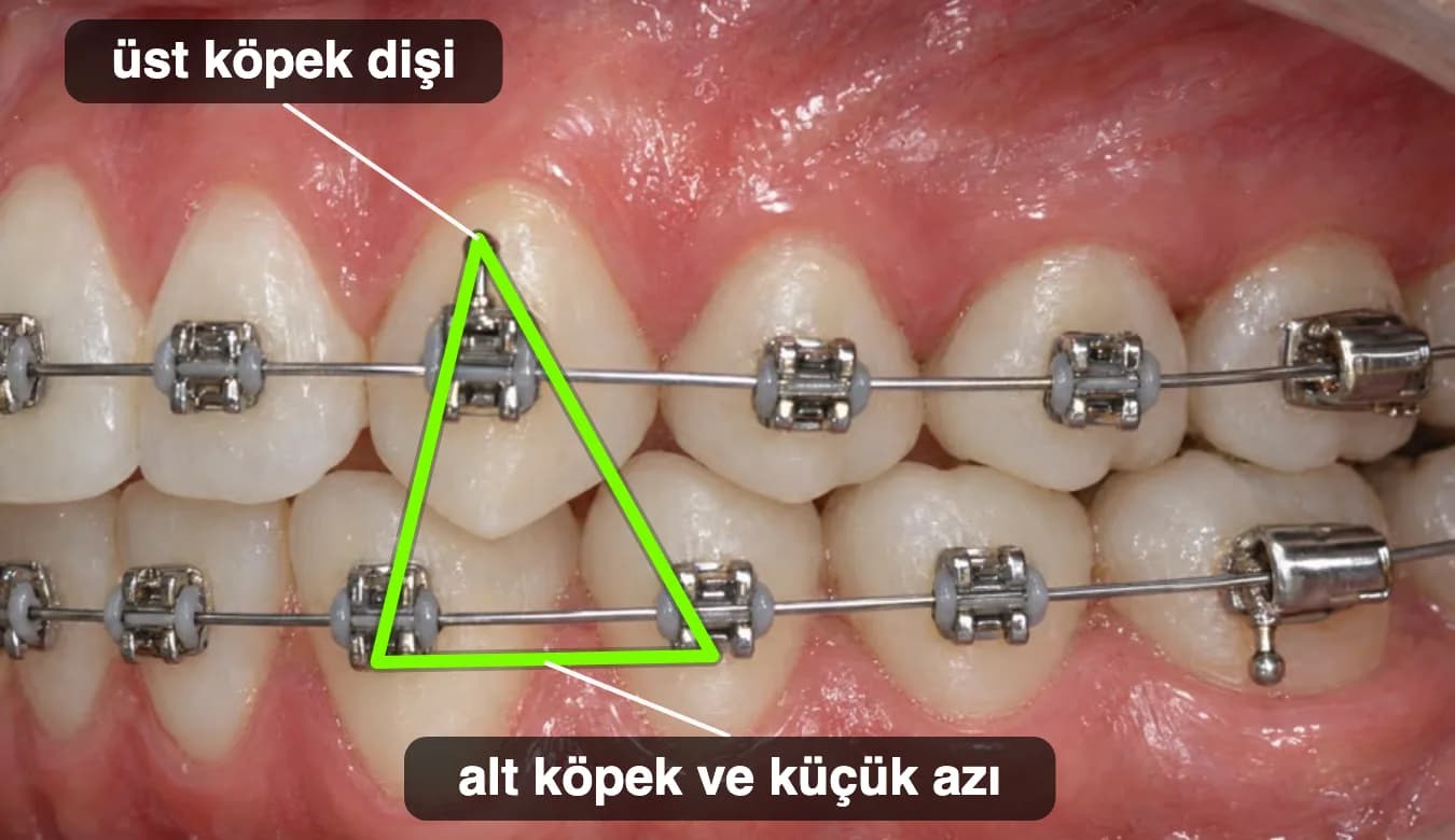 Üst köpek dişi ile alt köpek ve küçük azı dişleri arasında üçgen şeklinde takılmış lastik.