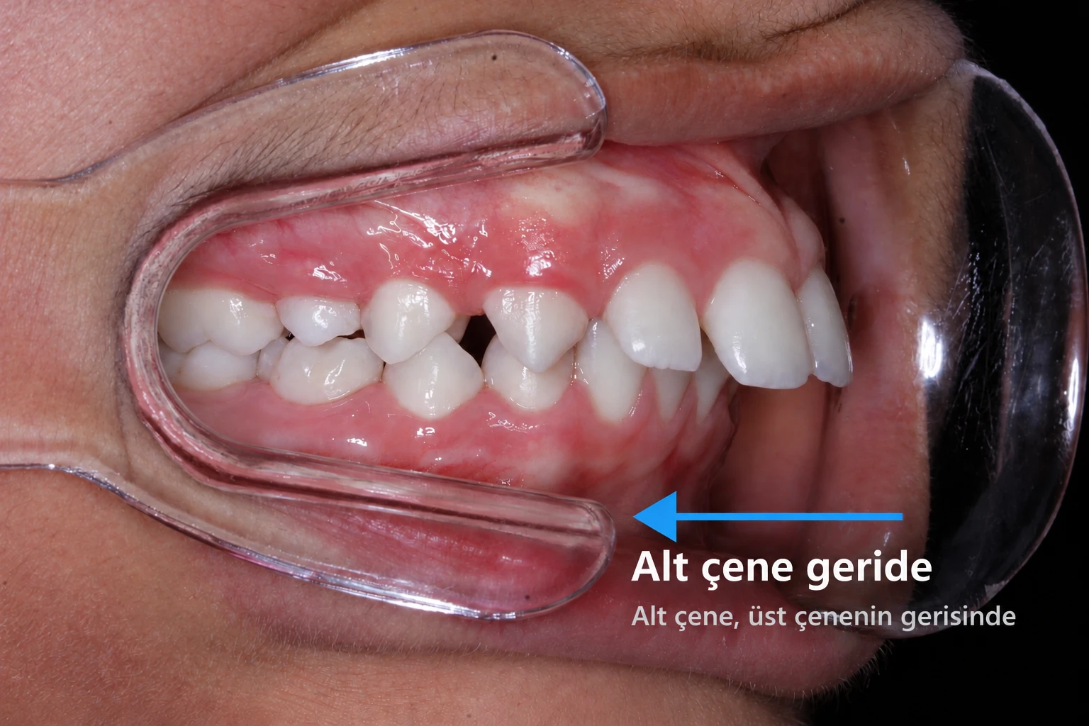 Alt çene geriliği gösteren ağız içi fotoğraf: alt çene üst çenenin gerisinde kalmış, üst ön dişler öne çıkmış görünüyor.