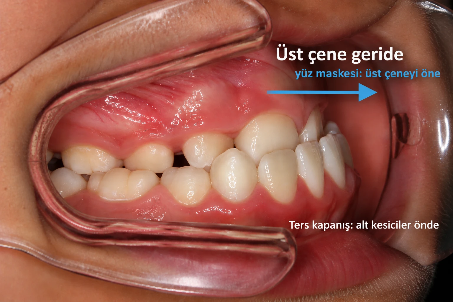 Üst çene geriliği gösteren ağız içi fotoğraf: ters kapanış, alt kesiciler üst kesicilerin önünde kapanıyor; ok yüz maskesinin üst çeneyi öne alma yönünü gösteriyor.